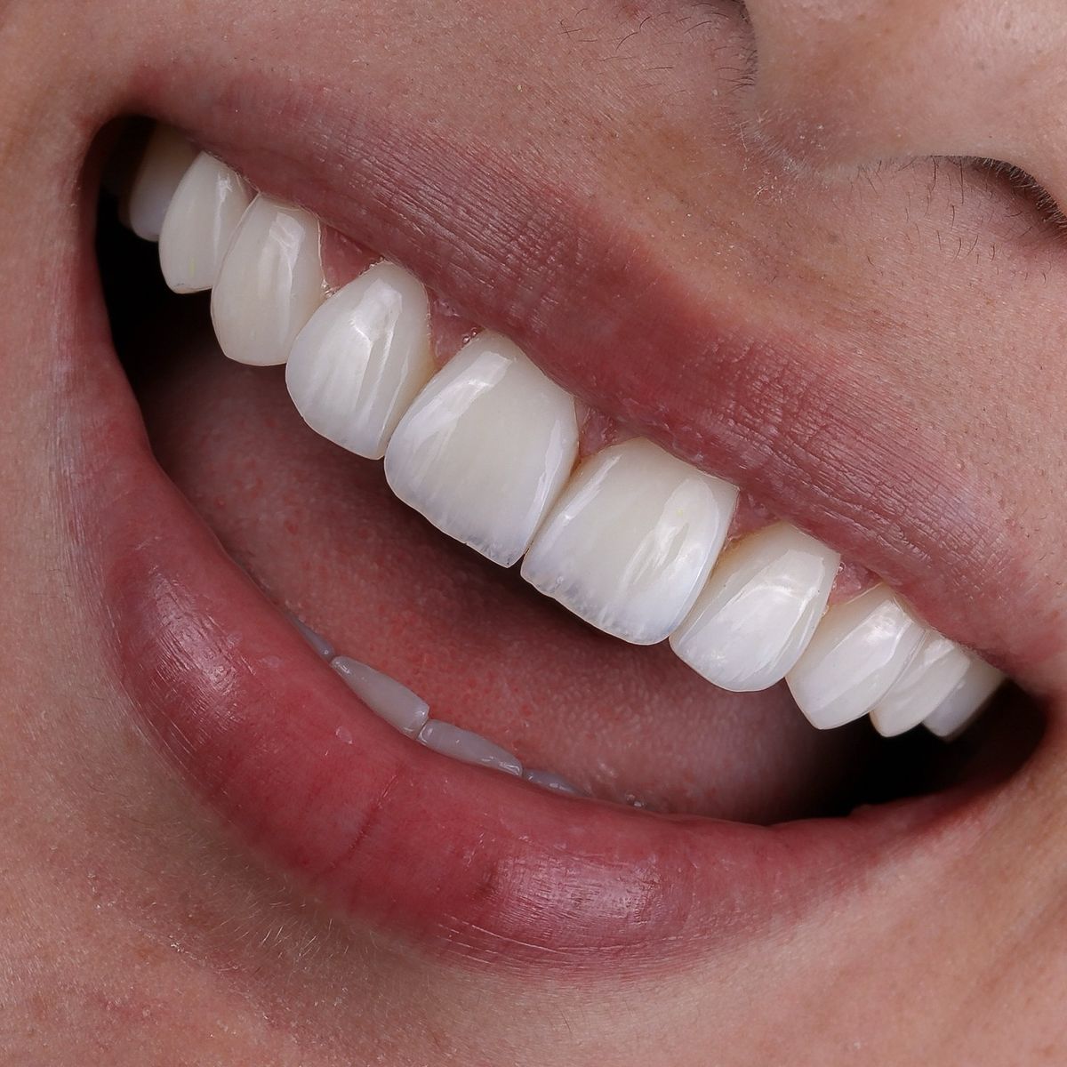 Smile Design